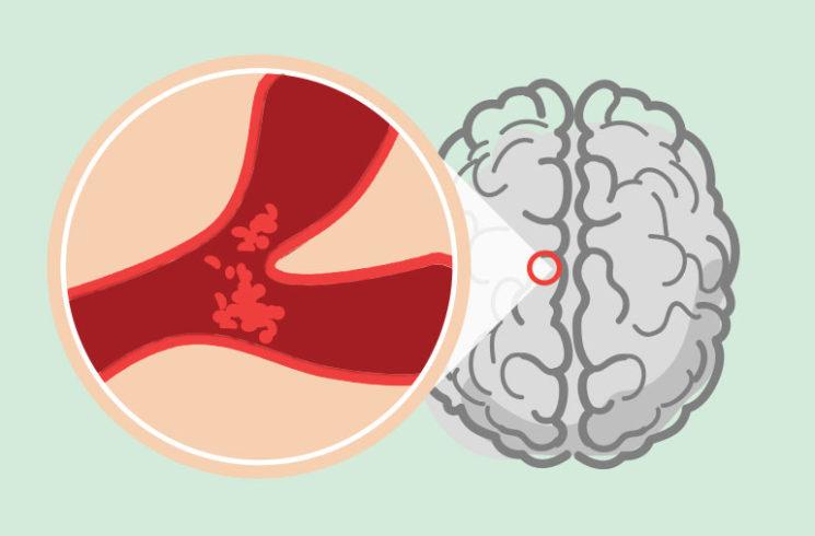 Tại sao bạn nên cẩn thận với cơn thiếu máu não thoáng qua (TIA)