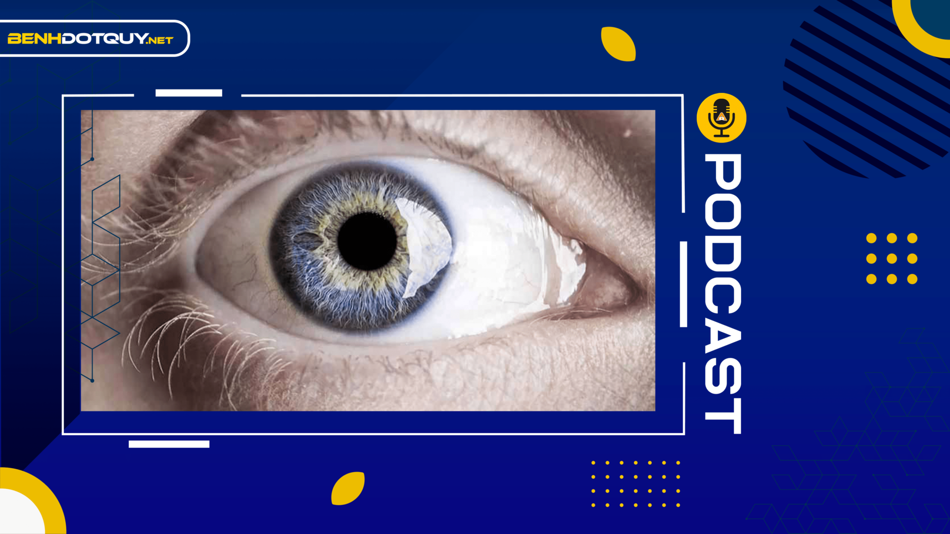 Bác sĩ chỉ ra dấu hiệu đột quỵ mắt cần chú ý