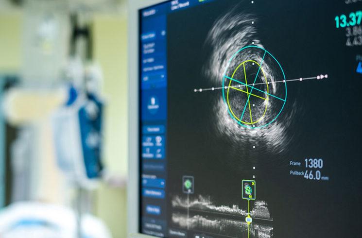 Có nên siêu âm và xét nghiệm sàng lọc để giúp phát hiện đau tim hoặc đột quỵ?