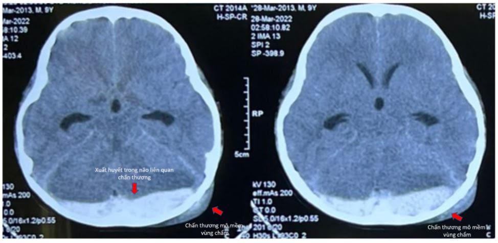 Trẻ nhỏ bị chấn thương sọ não, làm sao nhận ra dấu hiệu nguy hiểm tính mạng?