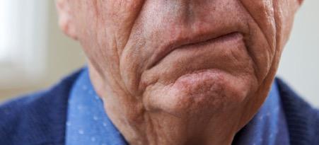 Méo miệng là một trong những triệu chứng đột quỵ ở nam giới và cả nữ giới.