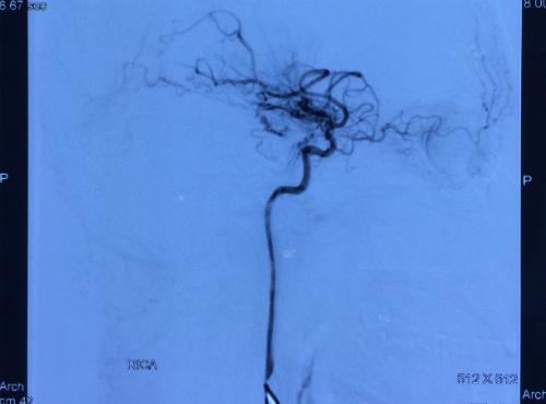 Hình ảnh mạch máu của trẻ bị bệnh Moya Moya - một loại bệnh lý tắc hẹp mạch não bẩm sinh