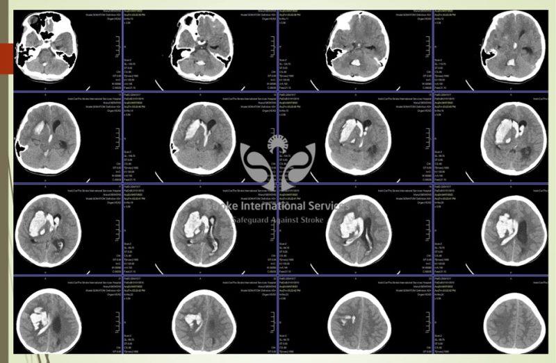 Hình ảnh xuất huyết não của bé 11 tuổi vừa được cấp cứu tối 7/4 tại Bệnh viện Đa khoa Quốc tế S.I.S Cần Thơ