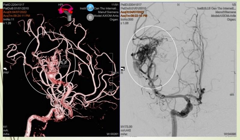 Đừng phí thời gian tự chữa tại nhà khi trẻ đau đầu, nôn ói, lừ đừ