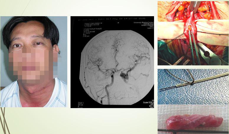 H. Bệnh nhân nam 34 tuổi bị rò động mạch xoang hang sau tai nạn giao thông, tái phát sau mổ thả cơ và cột động mạch cảnh năm 2004