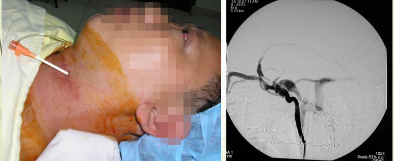 Các bác sĩ có quyết định khá mạo hiểm là chọc trực tiếp vào động mạch cảnh ở cổ, sau đó can thiệp đặt bóng.