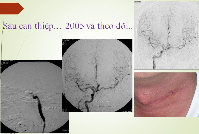 Sau can thiệp, bệnh nhân đã được điều trị hiệu quả, sau can thiệp không để lại sẹo vết đáng kể.