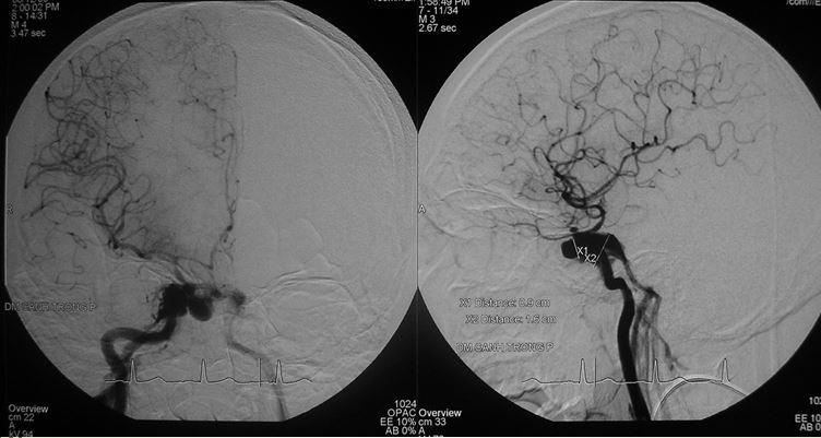 Hình ảnh DSA có giả phình trong xoang bướm gây chảy máu mũi họng ồ ạt