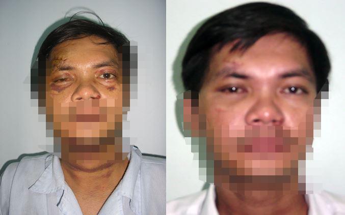 Bệnh nhân sau can thiệp