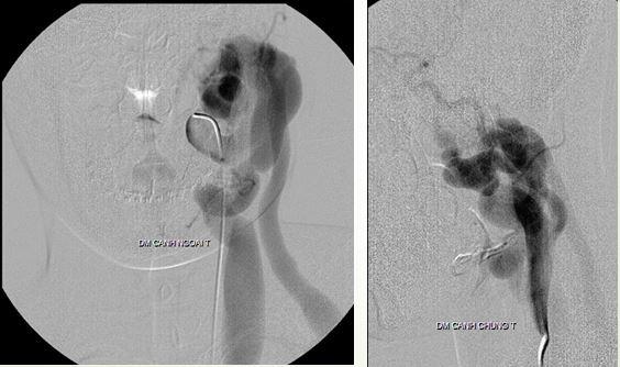 Rò động tĩnh mạch cảnh ngoài lưu lượng cao
