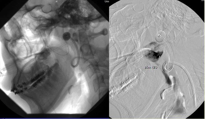 Kỹ thuật dùng bóng kiểm soát dòng chảy và gây tắc