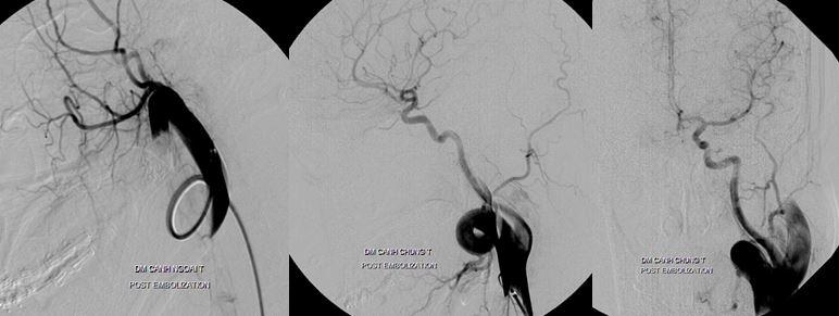 Bệnh nhân khỏi hoàn toàn sau can thiệp