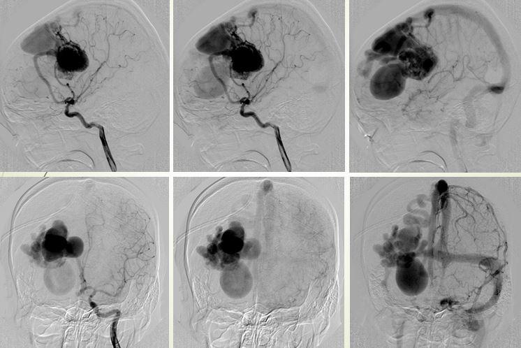 Dị dạng thông động tĩnh mạch não bẩm sinh AVM-AVF