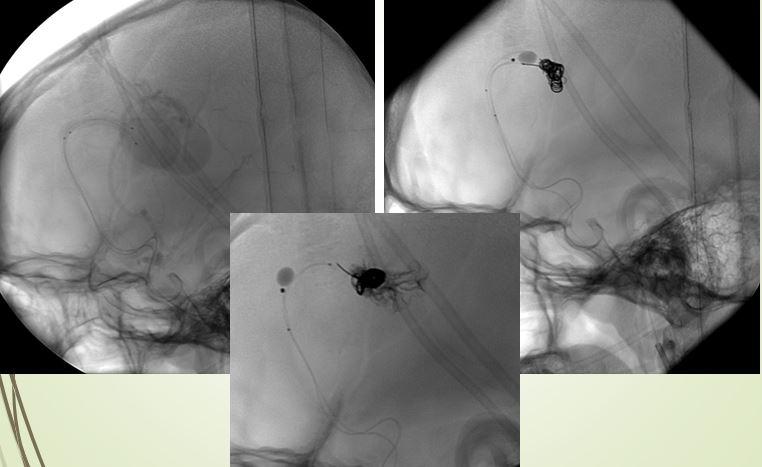 Hình ảnh DSA thực hiện kỹ thuật double catheter