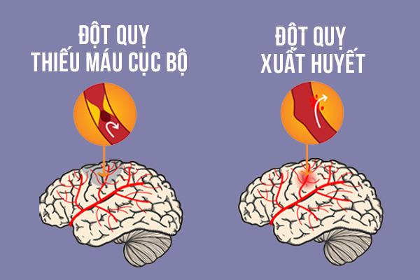 2 loại đột quỵ thường xảy ra ở người cao tuổi