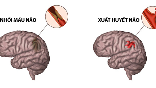 2 loại đột quỵ phổ biến
