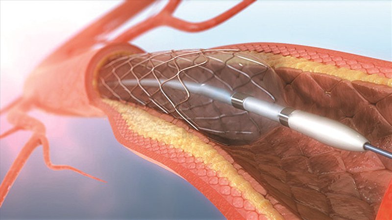 Đặt stent động mạch giúp phòng ngừa đột quỵ như thế nào?