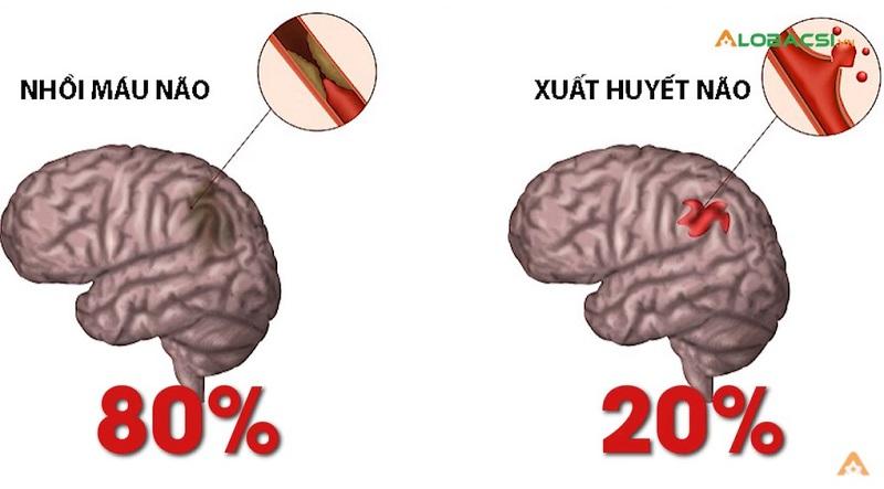 Trong các trường hợp đột quỵ, nhồi máu não xảy ra nhiều nhất.