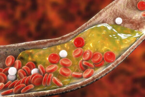 Cholesterol là một trong những yếu tố làm tăng nguy cơ đột quỵ đồi thị