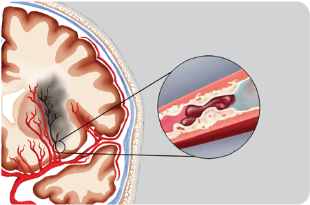 Thừa cholesterol là nguyên nhân gây đột quỵ?