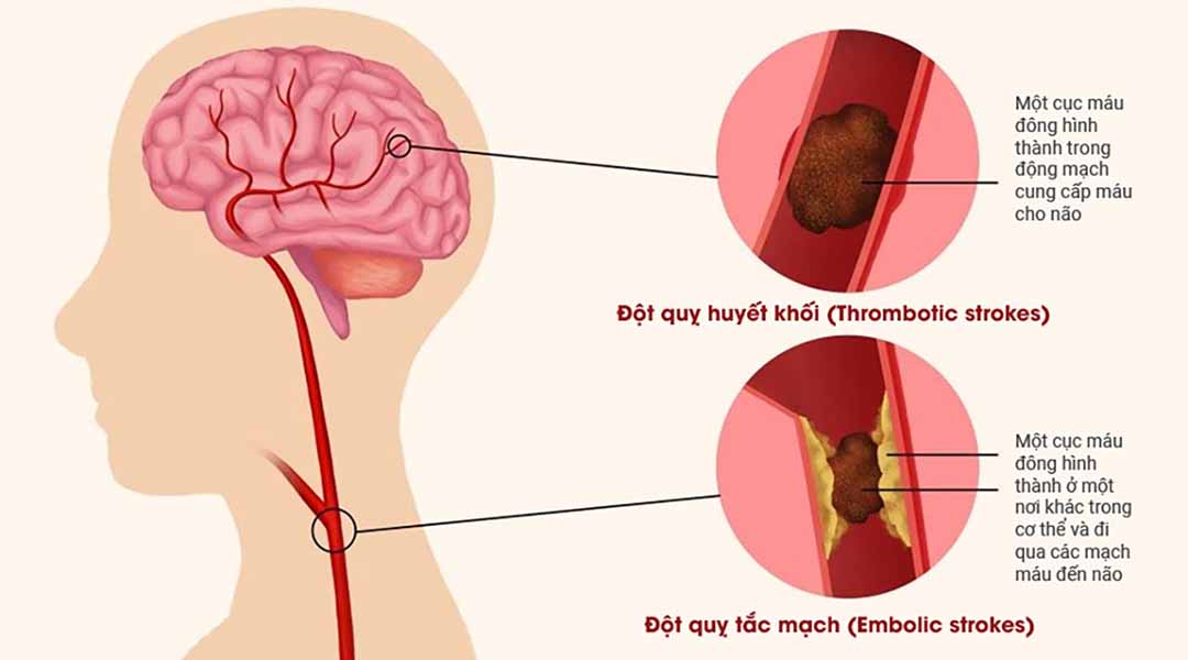 Đột quỵ nhồi máu não chiếm từ 70-80% trường hợp đột quỵ