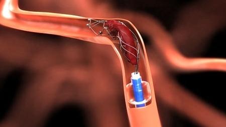 Phương pháp lấy huyết khối bằng dụng cụ cơ học ở bệnh nhân đột quỵ não.