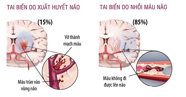Có hai loại đột quỵ chính là đột quỵ thiếu máu cục bộ và đột quỵ xuất huyết não, cả hai đều có thể ảnh hưởng đến thân não