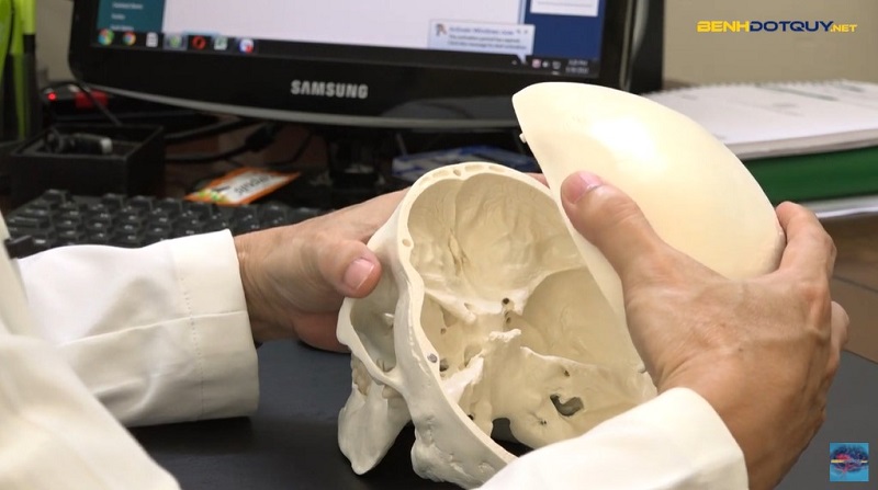 Đột quỵ là một trong 2 nguyên nhân gây áp lực nội sọ