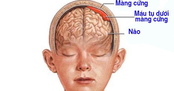 Máu tụ dưới màng cứng là khối tụ máu hình thành trong trong khoang dưới màng cứng.
