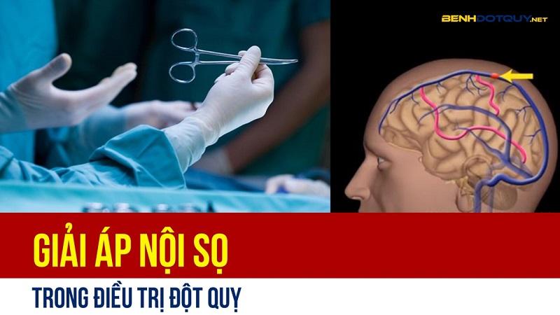 Giải áp nội sọ trong điều trị đột quỵ tiến hành thế nào?