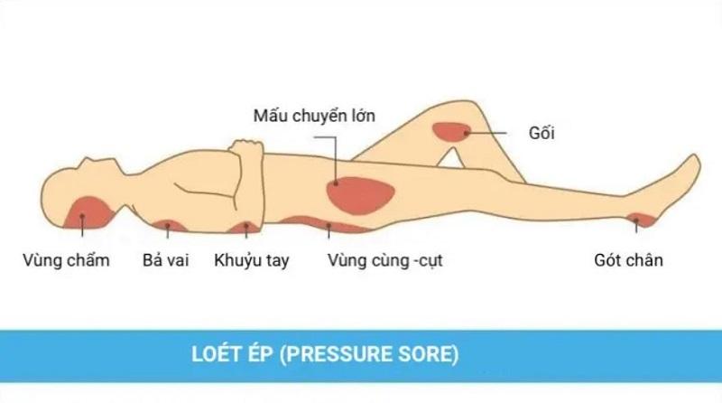 Các vị trí bệnh nhân đột quỵ có thể bị loét tì đè do nằm lâu, ít vận động.