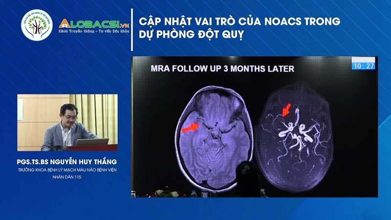 Cập nhật vai trò của NOACs trong dự phòng đột quỵ