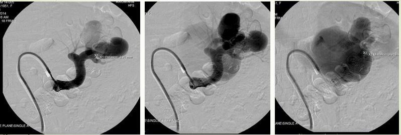 Kỹ thuật dùng bóng kiểm soát dòng chảy và bơm keo