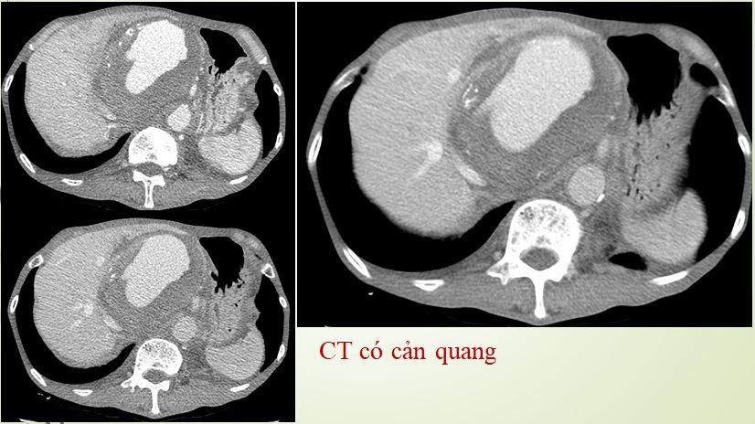 Hình ảnh CT cho thấy túi phình mạch máu khổng lồ trong gan, sát thành bụng
