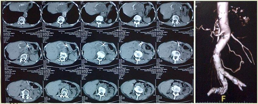 Hình ảnh sau can thiệp, túi phình "biến mất"