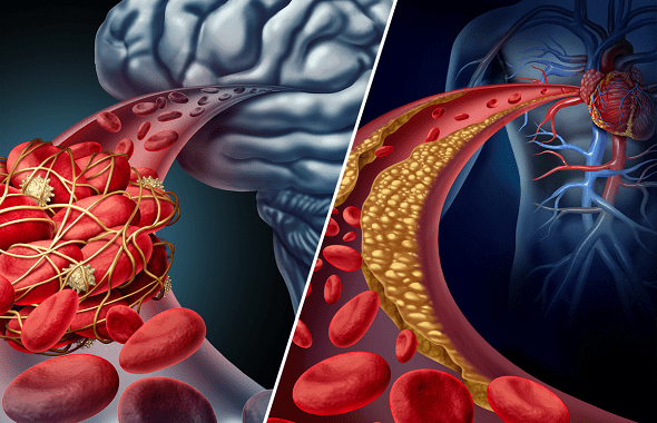 Đau tim và đột quỵ đều xảy ra do sự tắc nghẽn của động mạch cấp máu tới cho 2 bộ phận quan trọng của cơ thể là tim và não.