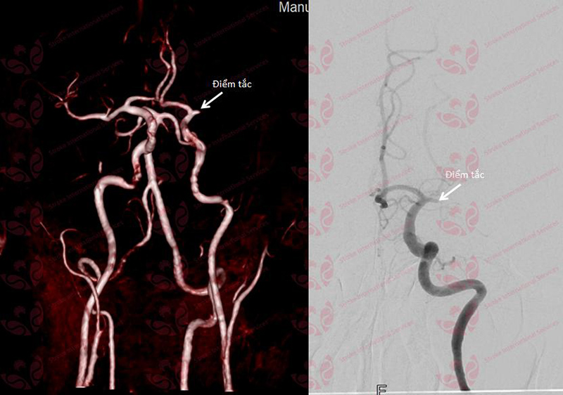 Hình ảnh tắc mạch máu não
