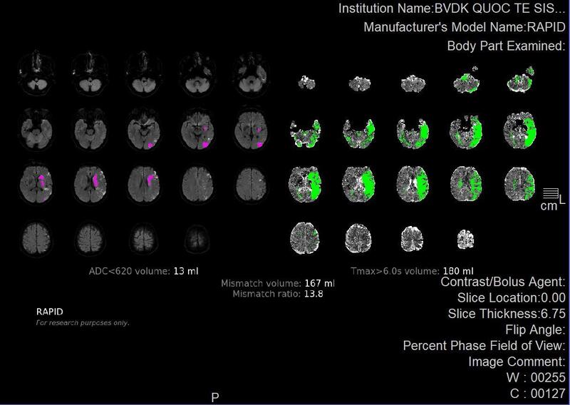 Phần mềm RAPID giúp đánh giá vùng tổn thương, vùng nhồi máu ở bệnh nhân đột quỵ