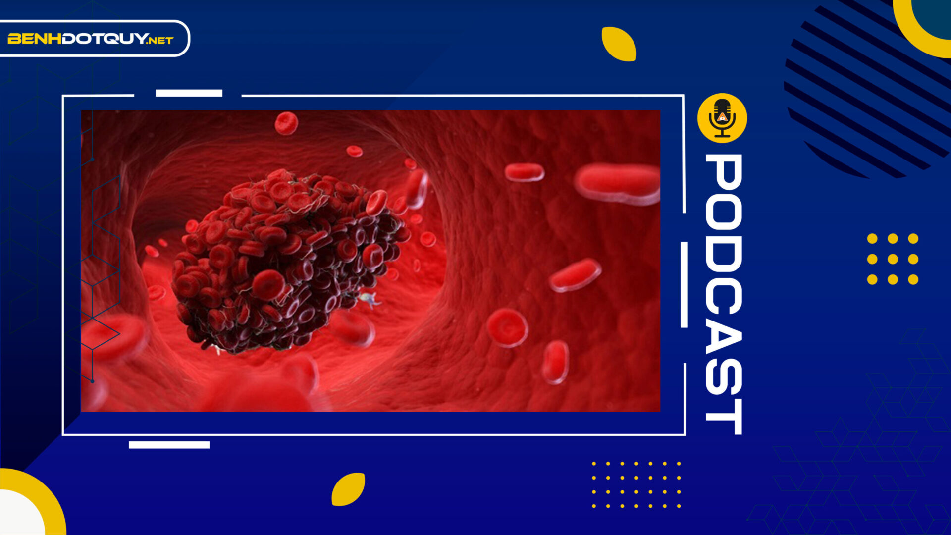 Lo sợ di chứng cục máu đông hậu COVID-19 gây đột quỵ: Chuyên gia chỉ cách dự phòng