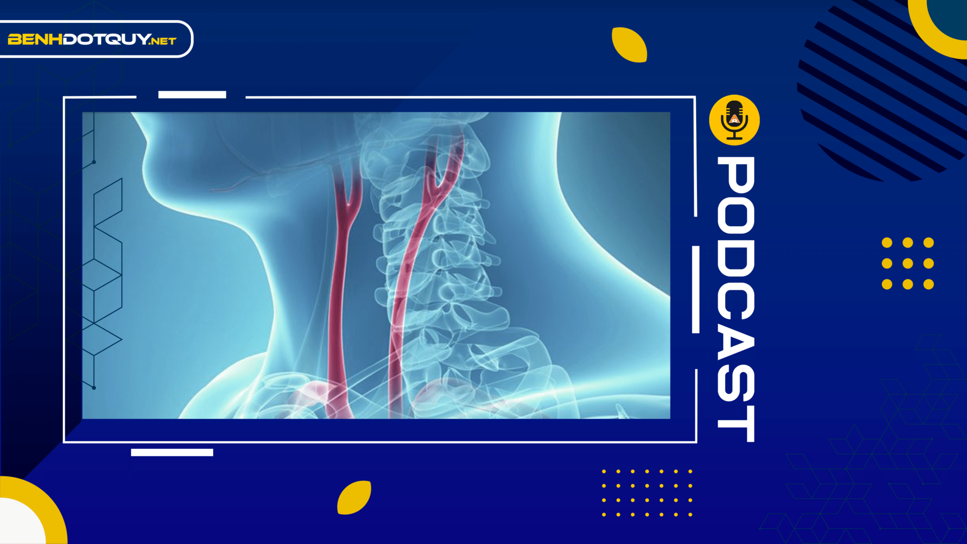 Hẹp động mạch cảnh có thể dẫn đến đột quỵ