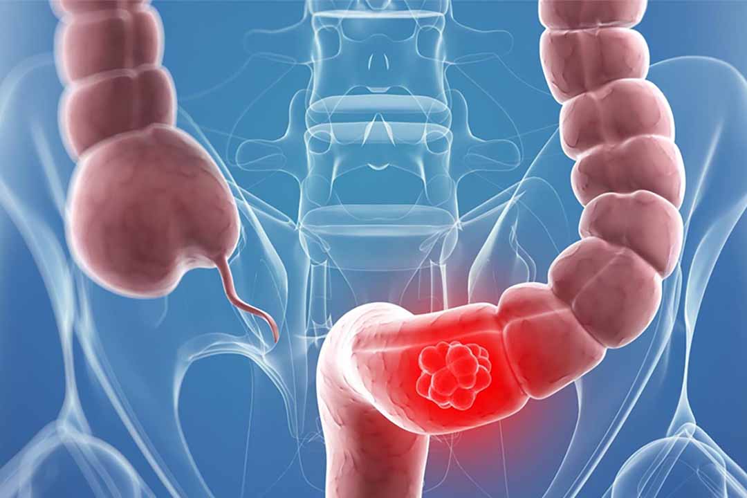 Nguyên nhân và cách khắc phục tình trạng táo bón sau đột quỵ