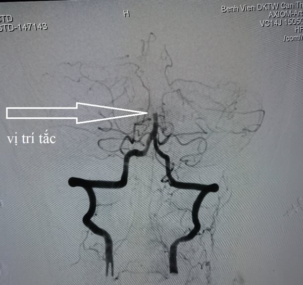 không được phát hiện sớm và cấp cứu ngay
