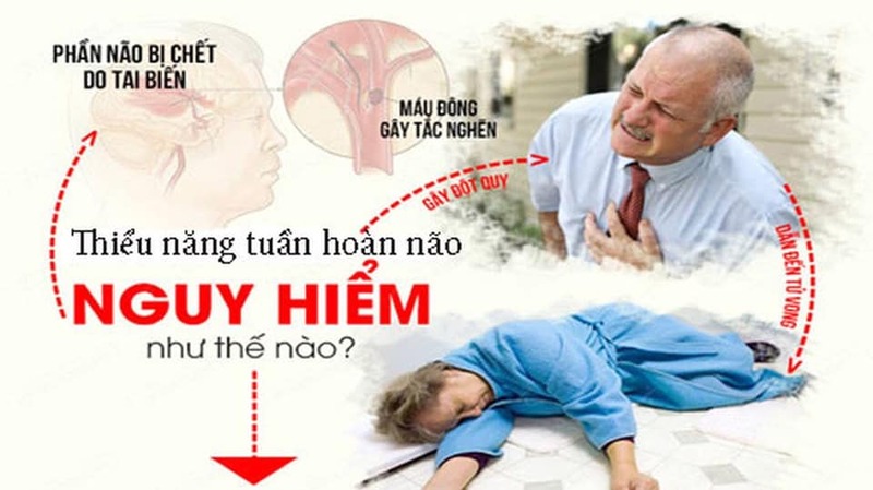 Thiểu năng tuần hoàn não: Biểu hiện của đột quỵ tiềm ẩn