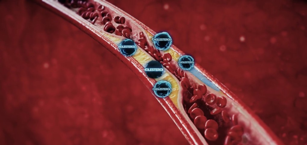 Tại sao thừa cholesterol lại liên quan đến đột quỵ?