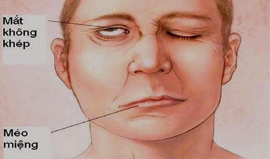 Trúng gió thường bị nhầm lẫn với đột quỵ vì có biểu hiện méo miệng