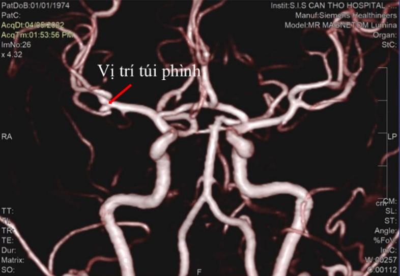 Bệnh nhân nước ngoài về Việt Nam tái khám bệnh đau đầu