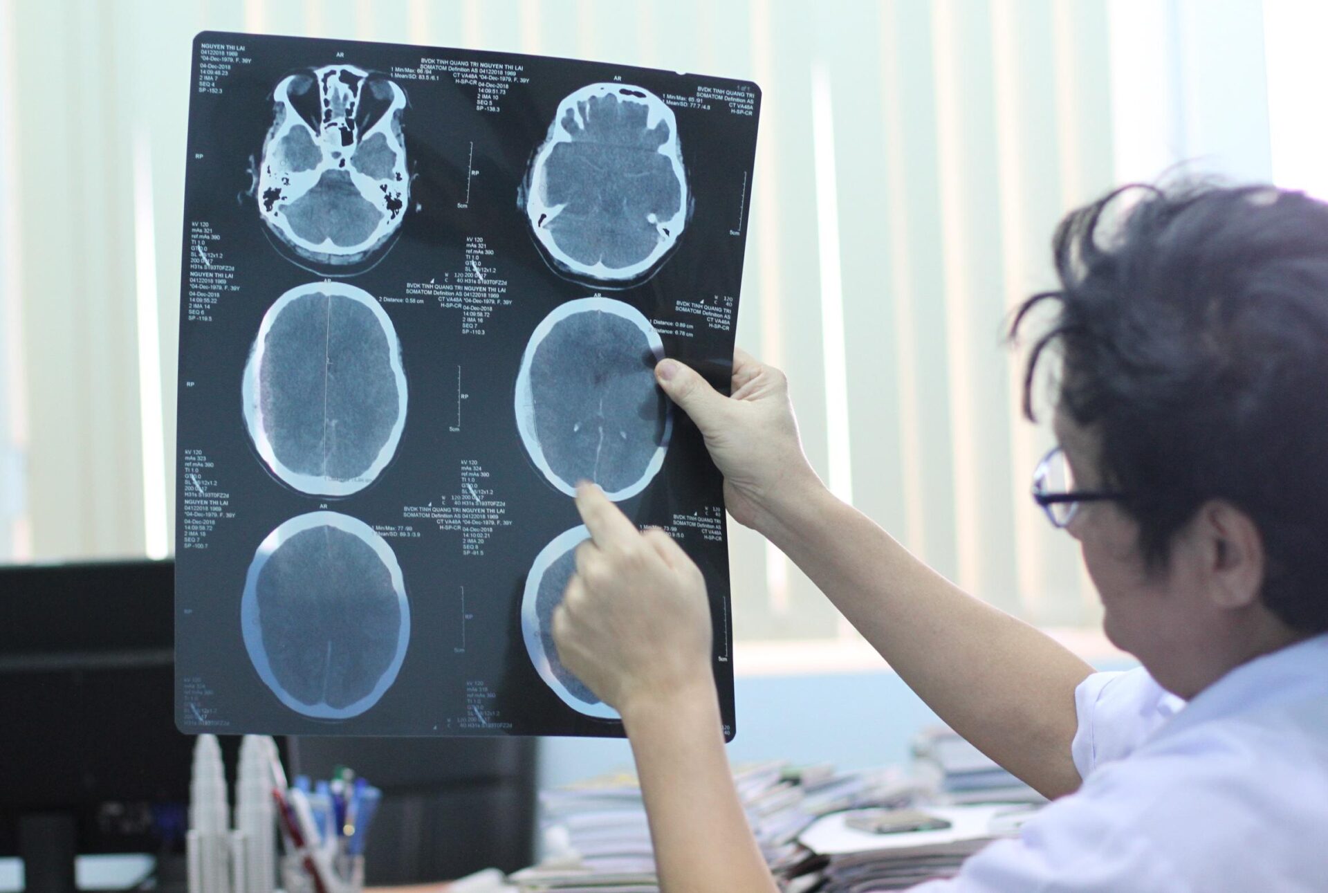 Cách chẩn đoán bệnh nhân bị xuất huyết dưới nhện?