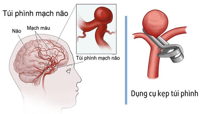 Nút túi phình động mạch