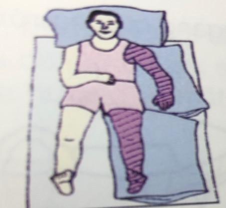 Nằm ngửa: đặt gối nâng đở dưới vai và tay, chân bên liệt