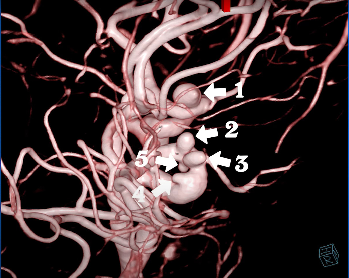 Kết quả chụp MRI cho thấy 4 túi phình bên phải, 1 túi bên trái